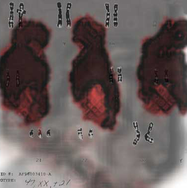 amniocentesis print